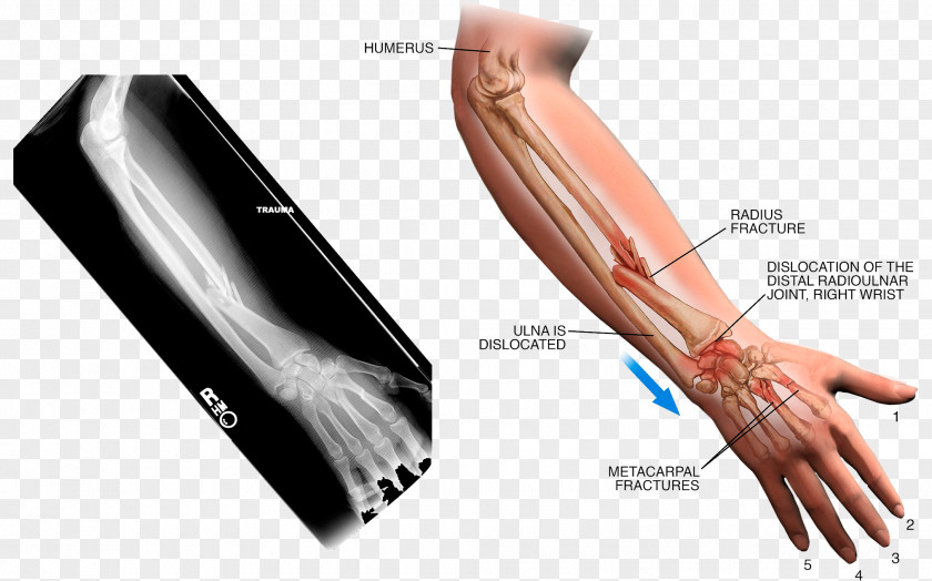 Arm Sprained Thumb Sprain X-ray PNG