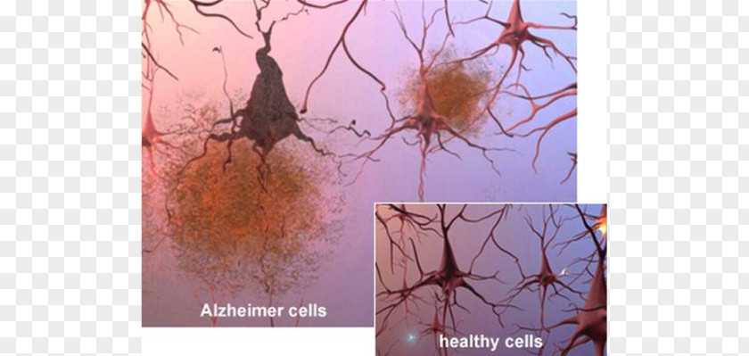 Alzheimer's Disease Association Brain Amyloid Beta Senile Plaques PNG