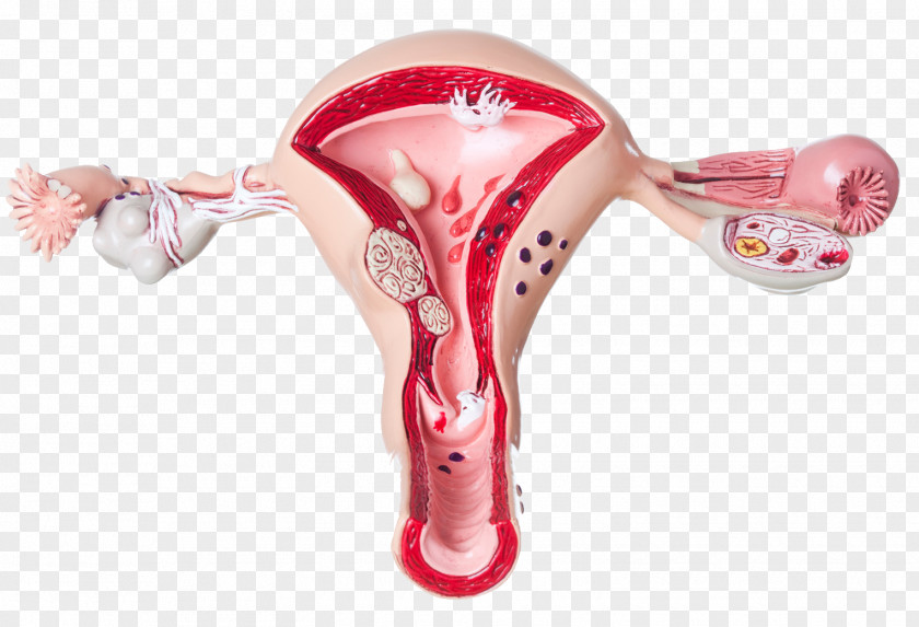 Female Uterine Medical Model Ovary Ovarian Cyst Pain Uterus Symptom PNG