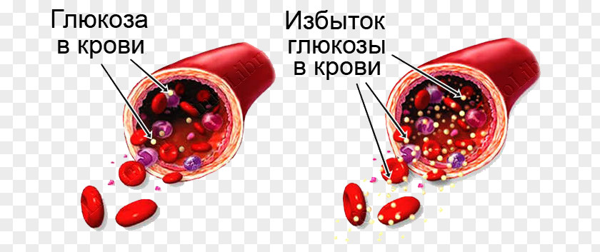 Blood Sugar Hypoglycemia Diabetes Mellitus Hyperglycemia PNG