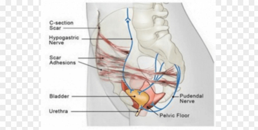 Scar Adhesion Caesarean Section Nerve Surgery PNG