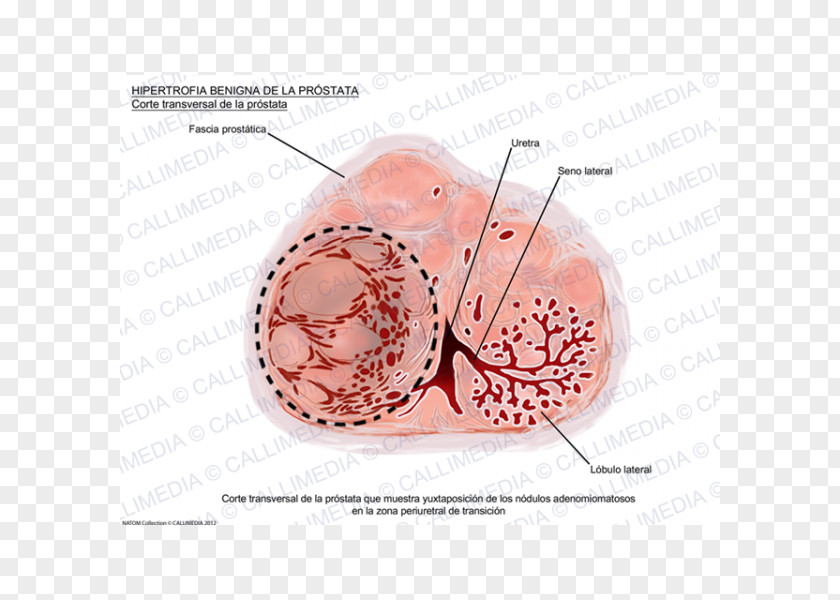 Prostate Gland Benign Prostatic Hyperplasia Cancer Hypertrophy Benignity PNG