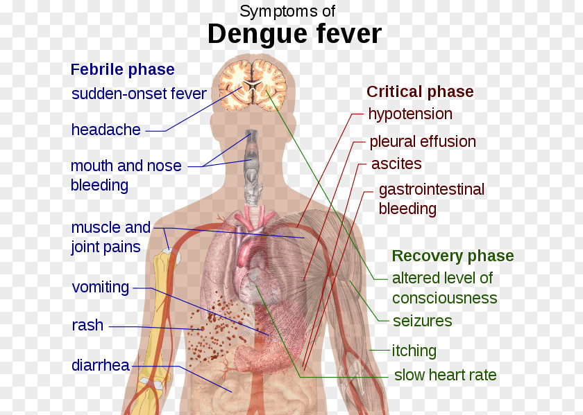 Dengue Symptomatic Treatment Fever Disease PNG