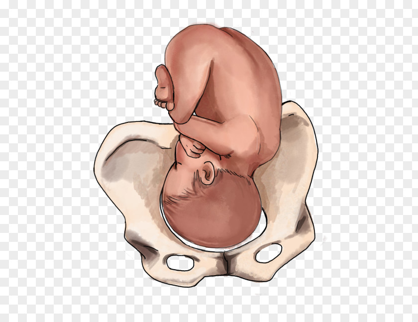 Pregnancy Childbirth Fetal Position Infant Breech Birth PNG