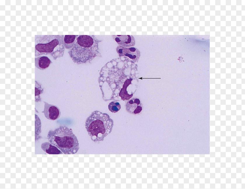 Crystal Chandeliers 14 0 2 Macrophage Body Fluid Pleural Effusion Hemosiderin PNG