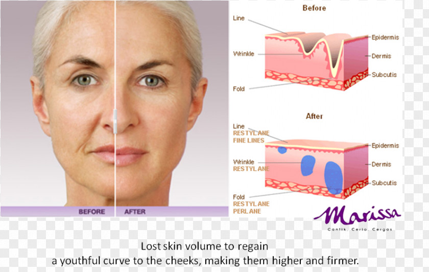 Muscle Tissue Injectable Filler Juvéderm Timeless Aesthetics MedSpa Hyaluronic Acid Cost PNG