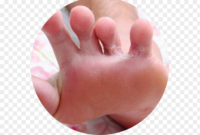 Athlete's Foot Ringworm Infection Mycosis PNG