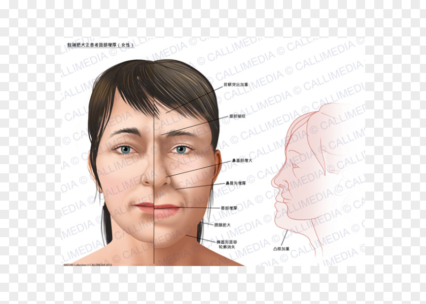 Face Acromegaly Gigantism Symptom Growth Hormone PNG