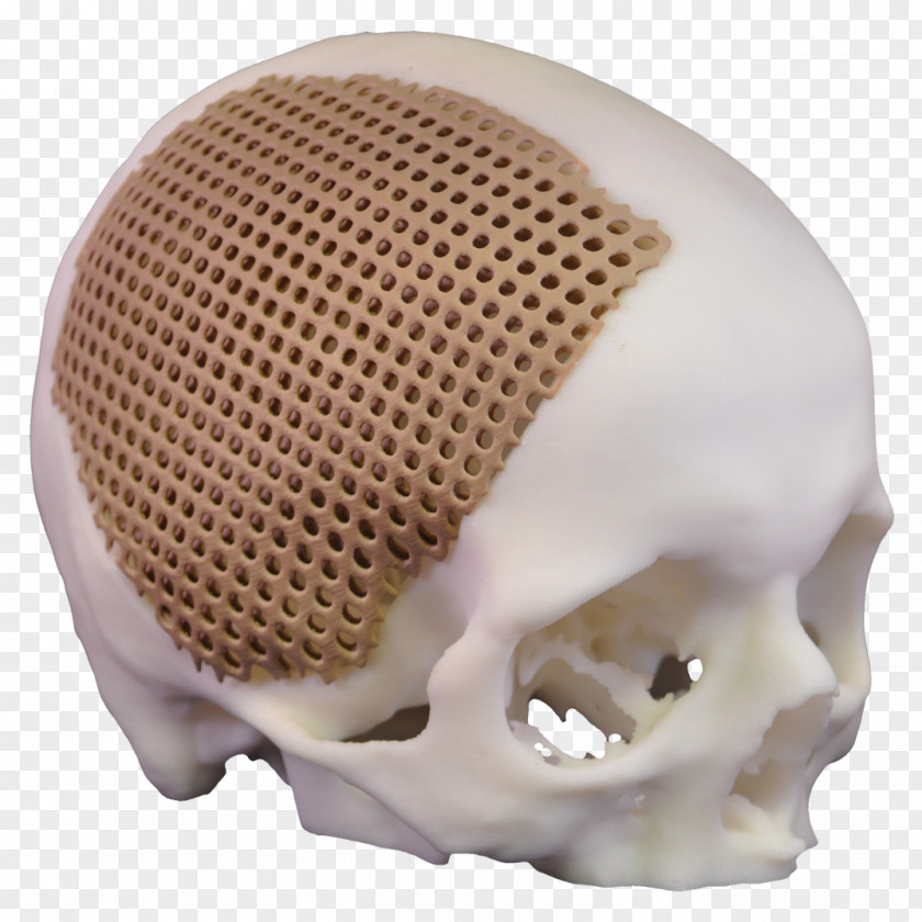 Skull Xilloc Bone Implant Jaw PNG