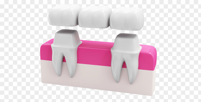 Bridge Dentistry Crown Dental Implant PNG