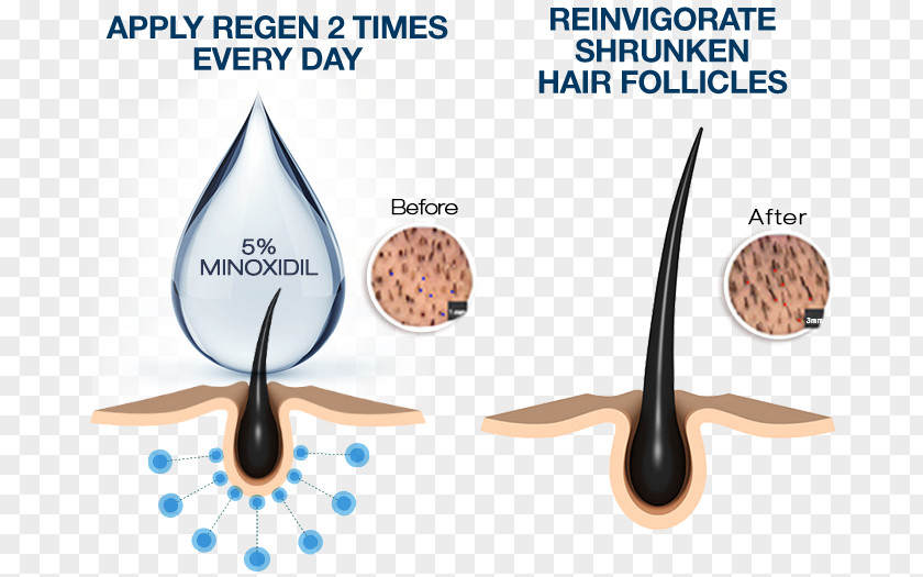 Hair Minoxidil Management Of Loss Follicle Human Growth PNG