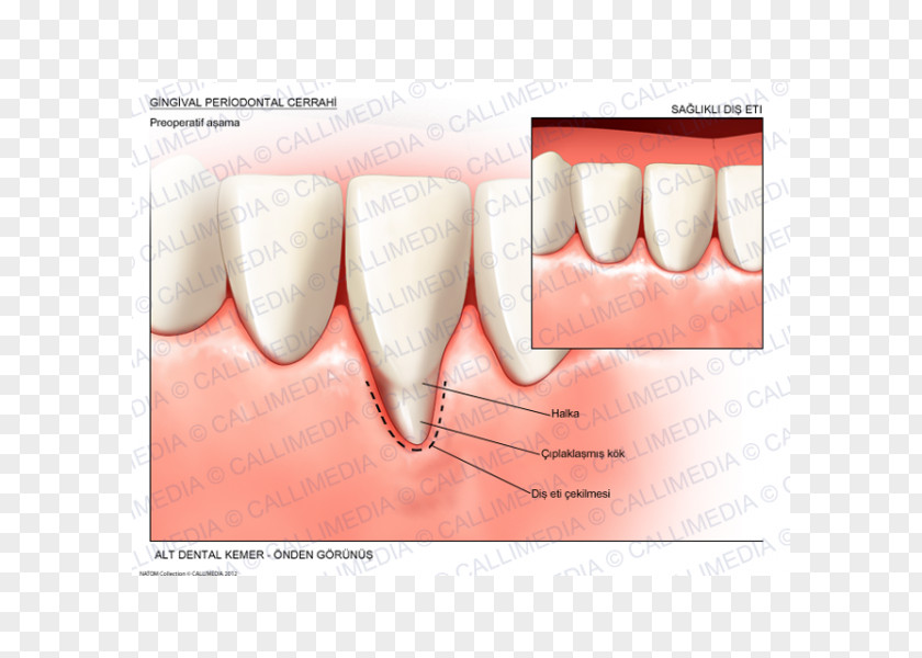Health Tooth Gums Gingival Recession Surgery Periodontal Disease PNG