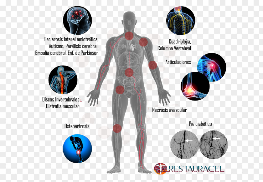 Artrosis De Rodilla Stem Cell Stem-cell Therapy Human Body PNG