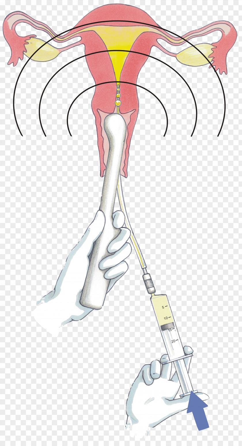 Hystero Contrast Sonography Hysterosalpingography Ultrasound Fallopian Tube Agent PNG