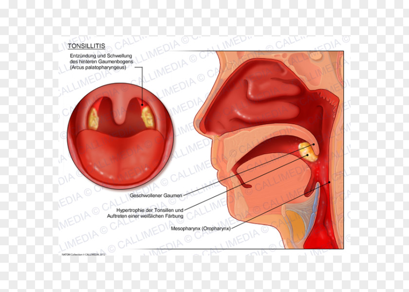 Nose Tonsillitis Otorhinolaryngology Pharyngitis Oropharyngeal Cancer PNG