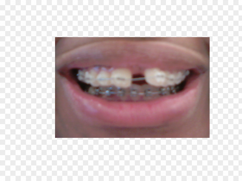 Braces Close-up PNG