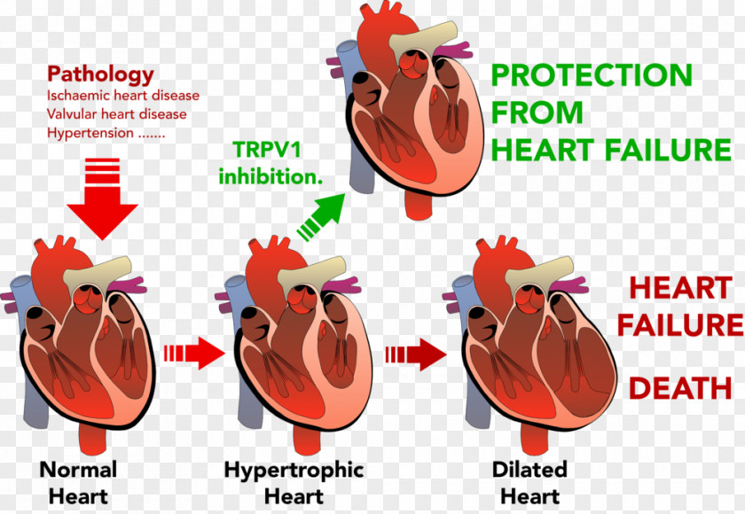 Heart Failure Ventricular Hypertrophy Cardiovascular Disease PNG
