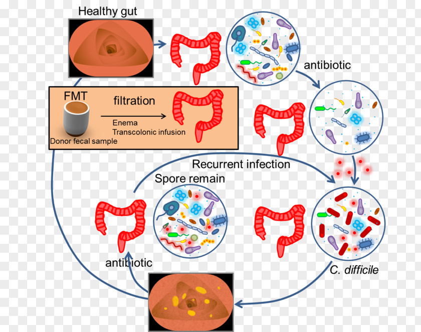 Fecal Microbiota Transplant Feces Ulcerative Colitis Gut Flora Faecal Calprotectin PNG