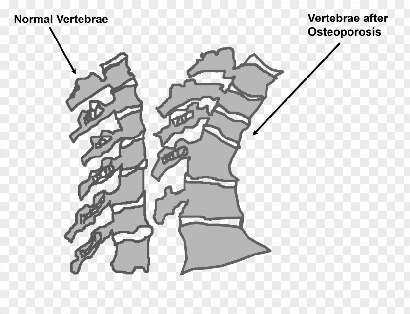 Health Osteoporosis Vertebral Column Bone PNG