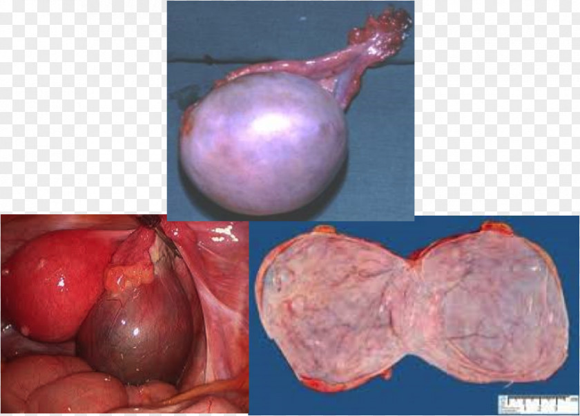 Myometrium Ovarian Serous Cystadenoma Shallot PNG