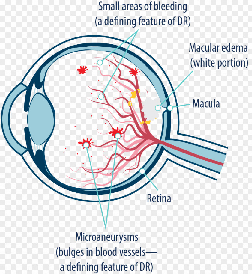 Eye Macular Edema Diabetic Retinopathy Macula Of Retina Degeneration Diabetes Mellitus PNG