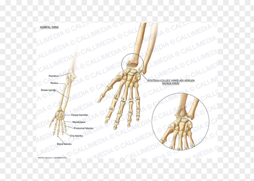 Pisiform Bone Fracture Carpal Bones Wrist PNG