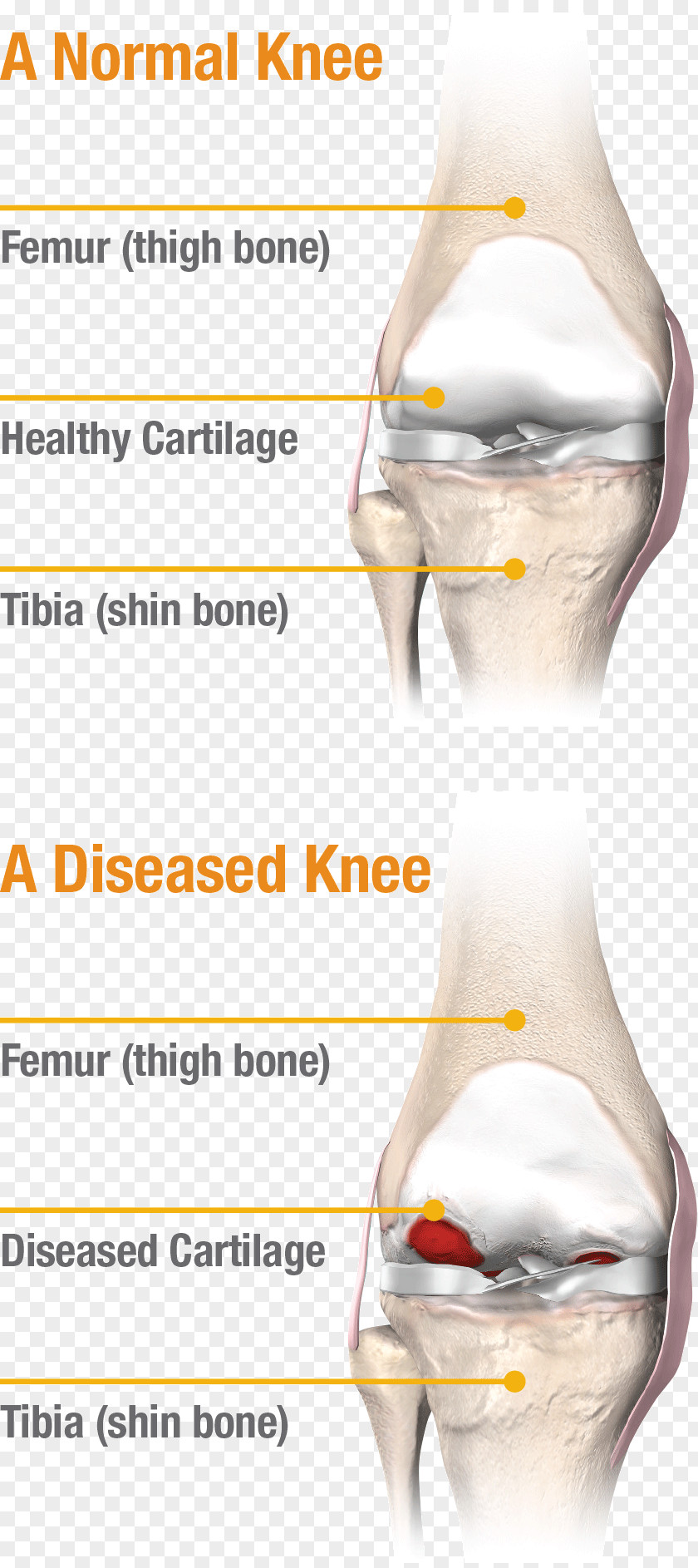 Knee Pain Joint Meniscus Replacement PNG