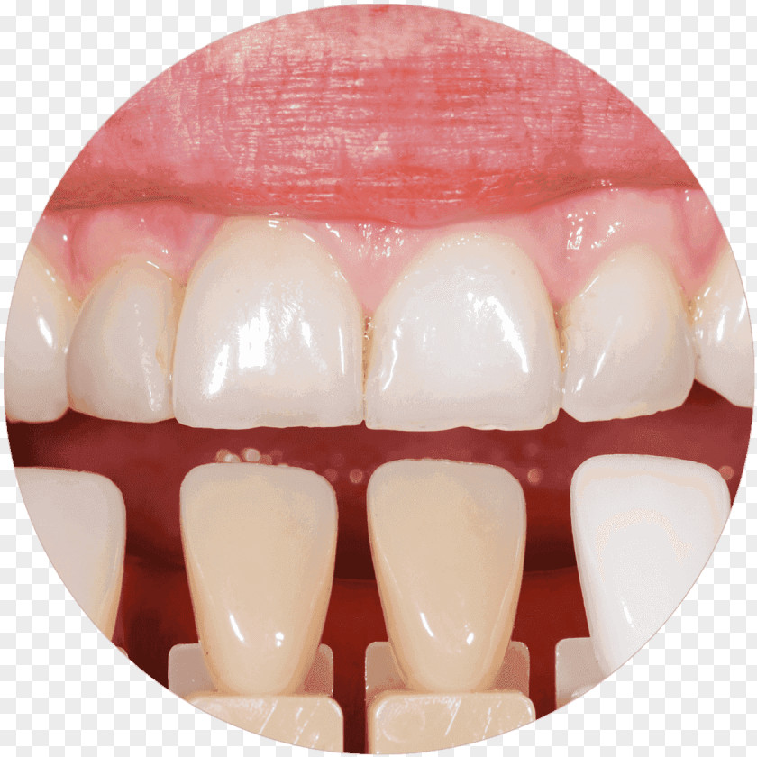 Crown Tooth Whitening Cosmetic Dentistry Veneer PNG