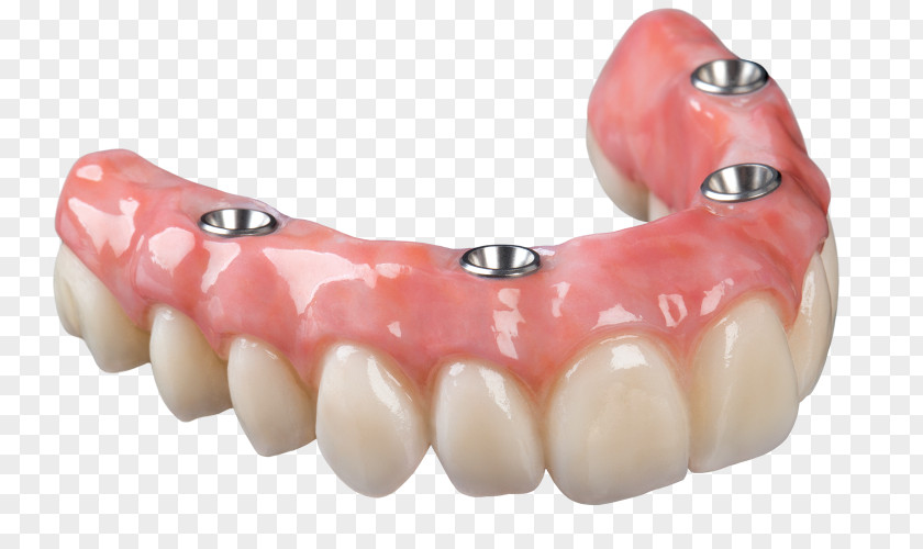 Dentistry Dental Implant Dentures All-on-4 Removable Partial Denture Bridge PNG