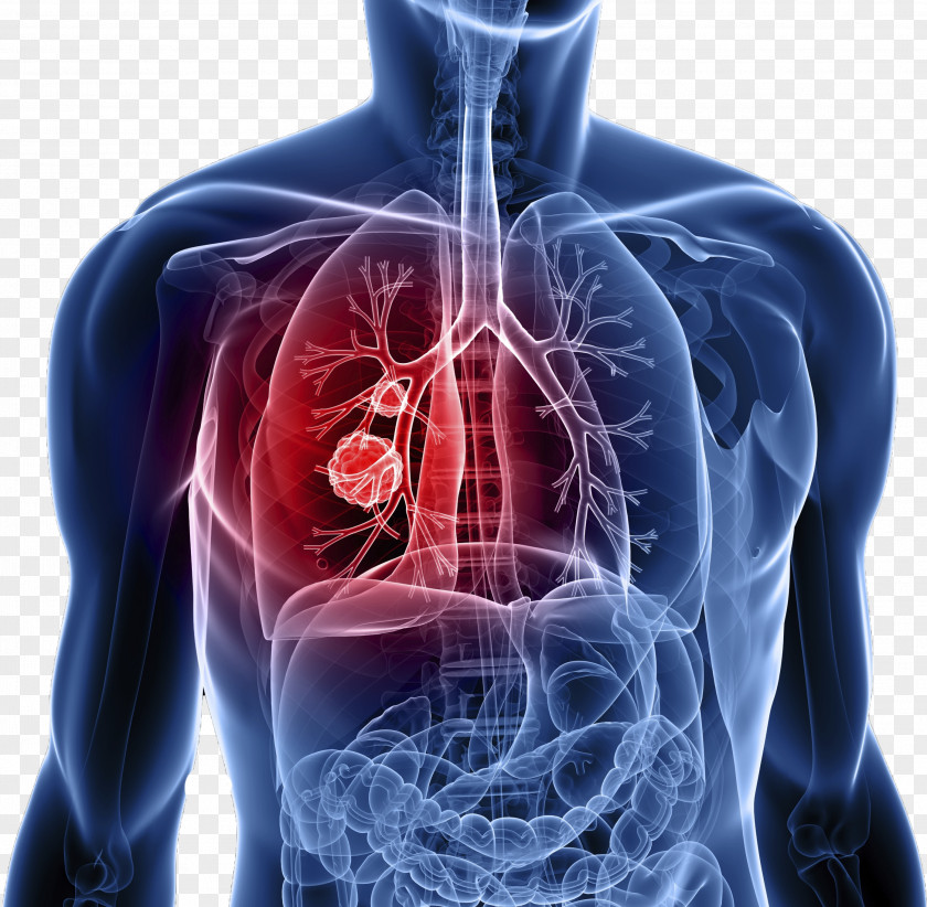 Cancer Cell Bodies Lung Symptom Metastasis PNG