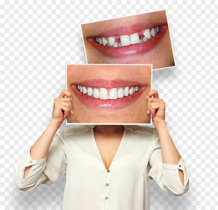 Smile Tooth Whitening Endodontic Therapy Dental Braces Dentistry PNG