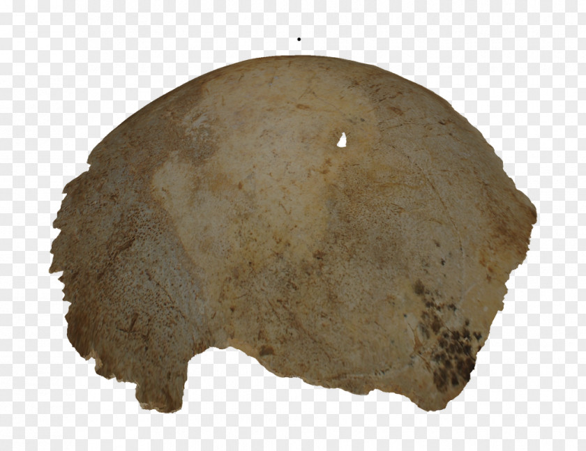 Diseases Disease Chronic Condition Bone B0126 Artifact PNG