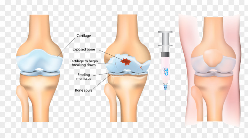 Health Stem-cell Therapy Osteoarthritis Platelet-rich Plasma Stem Cell Knee Arthritis PNG