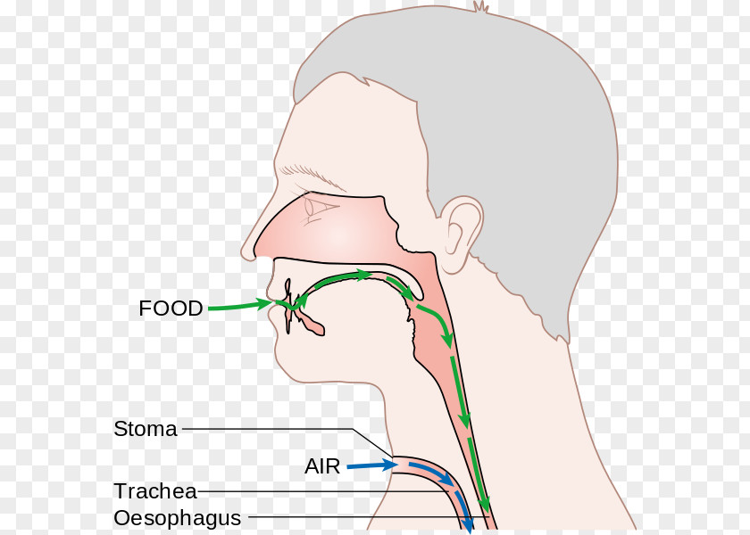 Nose Laryngectomy Voice Prosthesis Larynx PNG