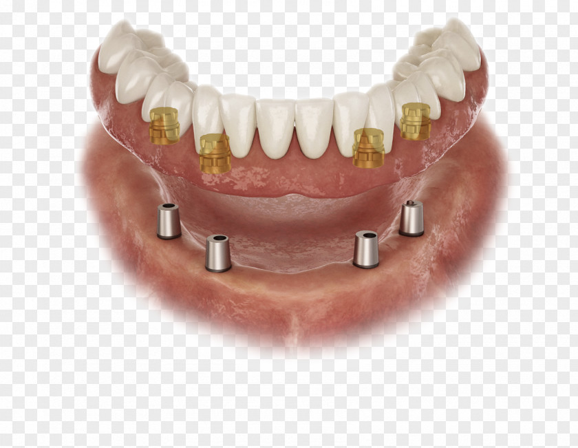 Crown Abutment Dental Implant Prosthesis Laboratory Dentures PNG