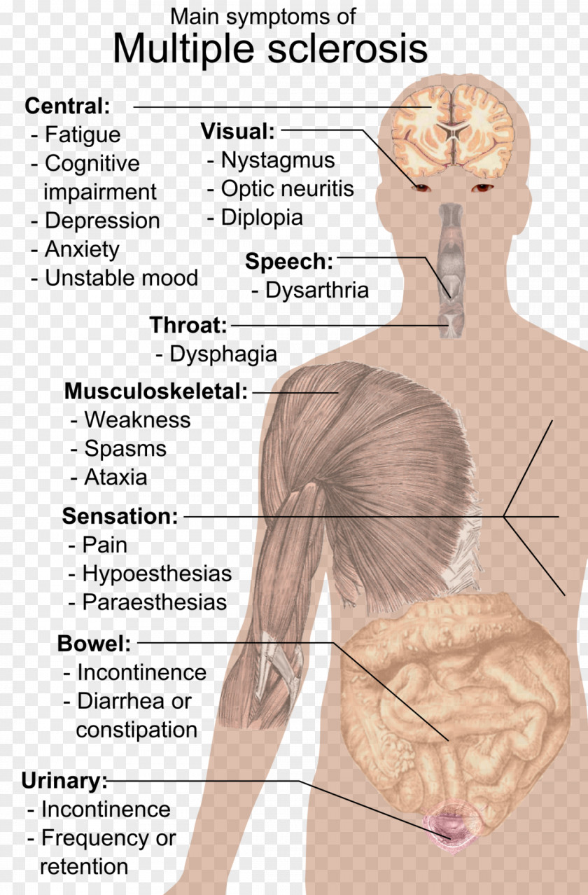 Liver Human Multiple Sclerosis Signs And Symptoms Medical Sign Disease PNG