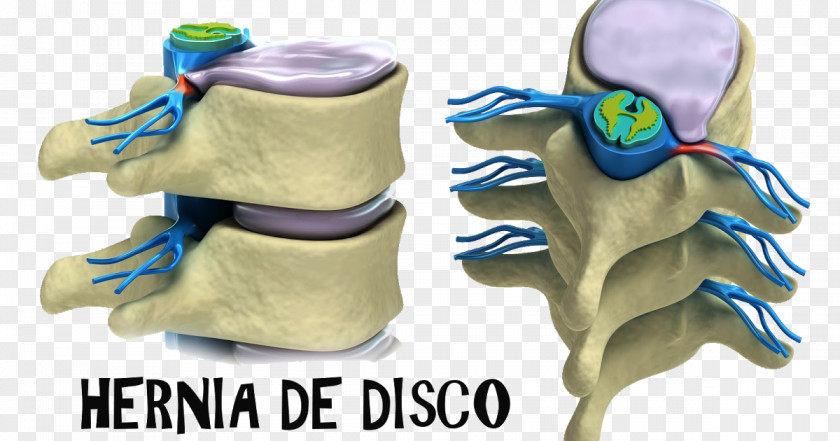 Spinal Disc Herniation Vertebral Column Lumbar Vertebrae Intervertebral Therapy PNG