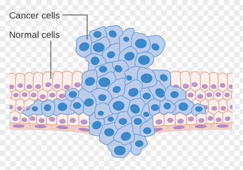 Various Cancer Cells Cell Metastasis Neoplasm PNG