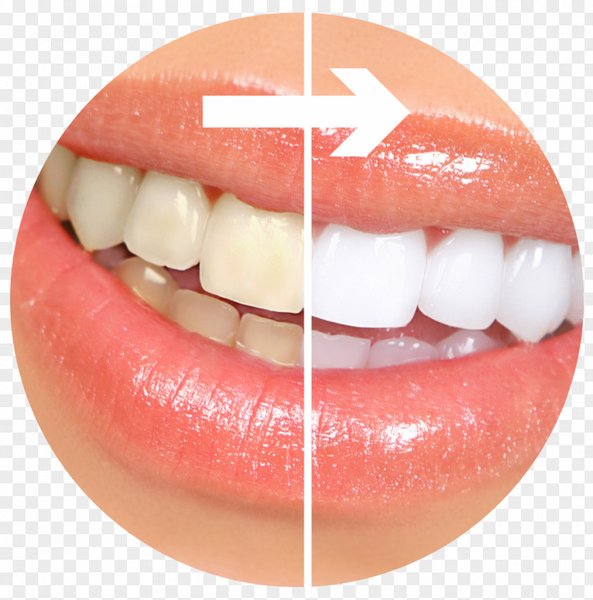 Toothpaste Tooth Whitening Cosmetic Dentistry Human PNG