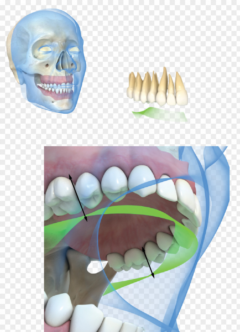 Strips Board Tooth Dental Implant Occlusion Gums PNG
