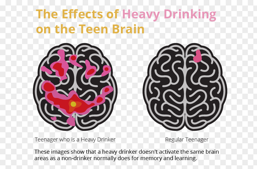 Brain Alcoholism Alcoholic Drink Alcohol And Health Binge Drinking PNG