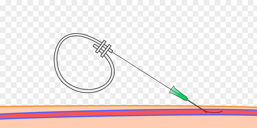Catheter Seldinger Technique Central Venous Angiography Interventional Radiology PNG