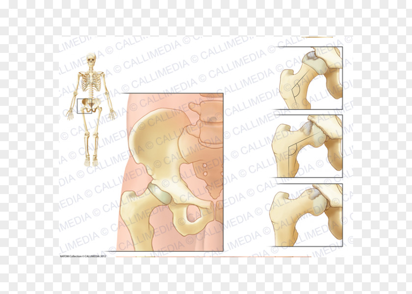 Ráº¯n 3d Hip Arthritis Femur Greater Trochanter Lesser PNG