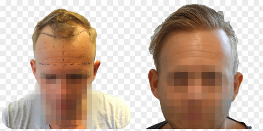 Hair Transplantation Follicular Unit Extraction Eyebrow Hairstyle PNG