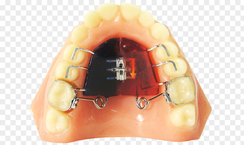 Ricoh Orthodontic Appliances Jaw Orthodontics Technology Quad HelixOthers ROA PNG