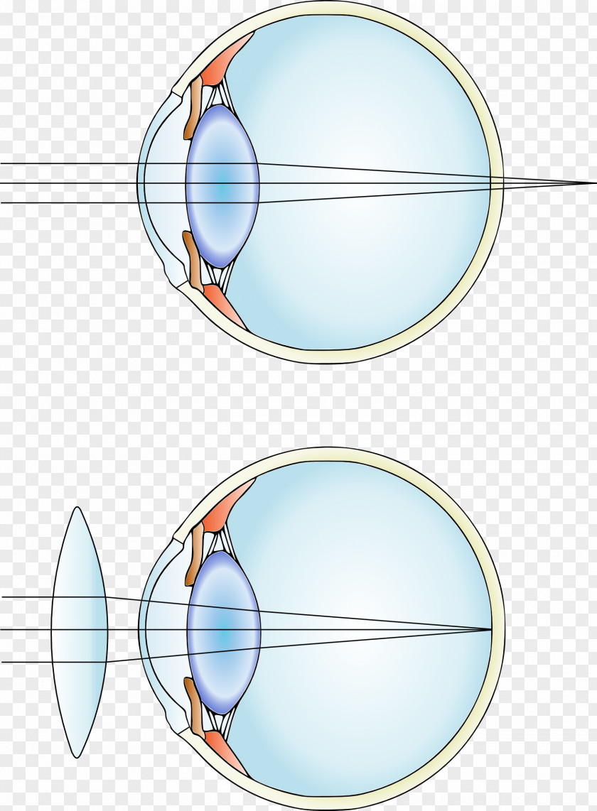 Eye Near-sightedness Corrective Lens Hypermetropia Contact Lenses PNG