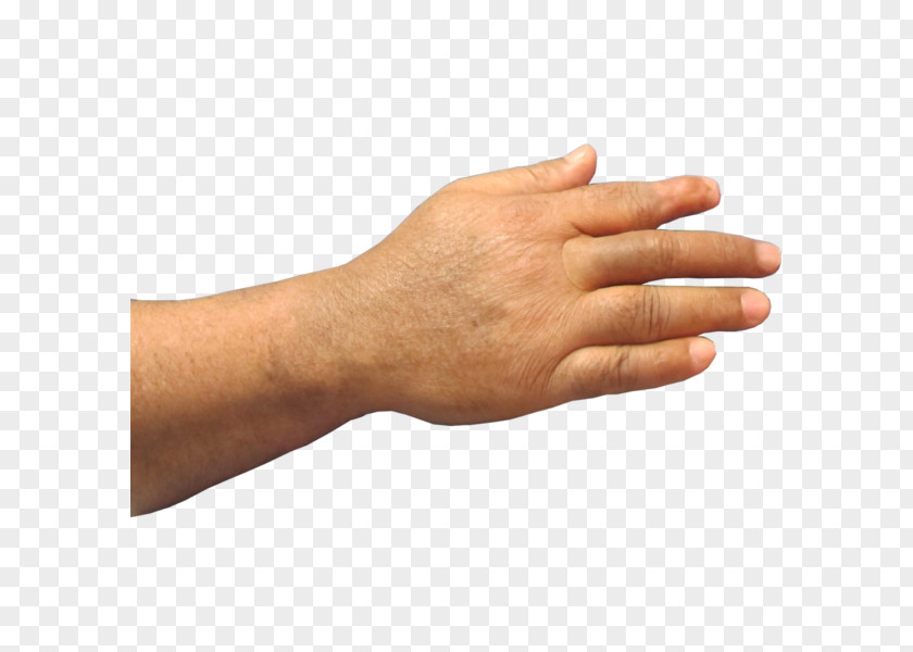 Hand Thumb Prosthesis Amputation Finger PNG