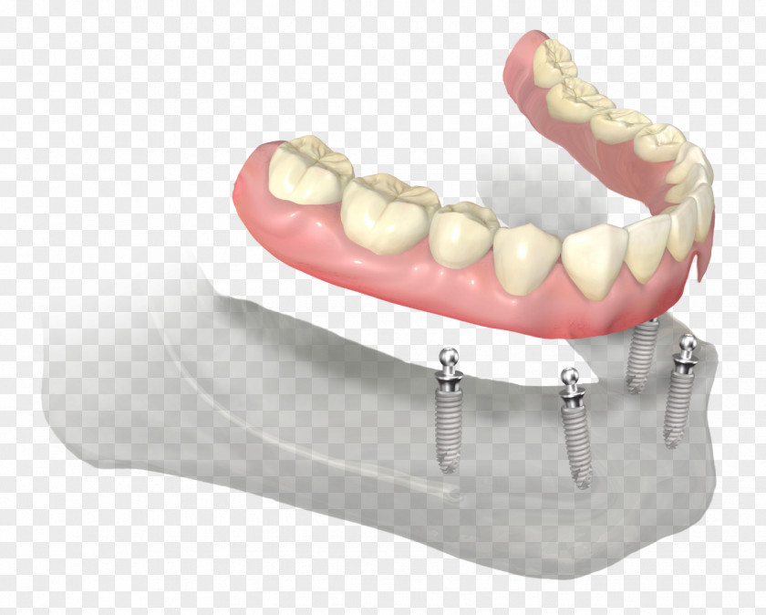 Teeth Dentures Dentistry Dental Implant Abutment Prosthesis PNG