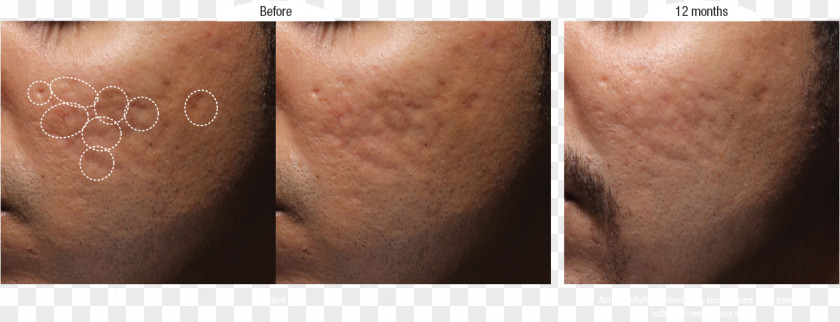Acne Scars Wrinkle Scar Injectable Filler Skin PNG