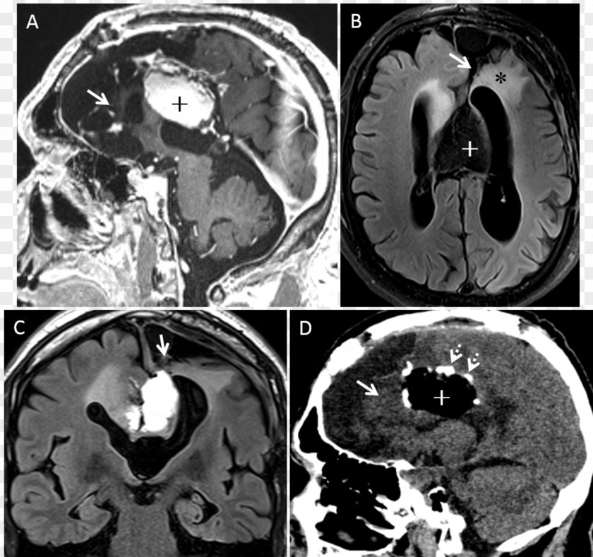 Brain Computed Tomography Fluid-attenuated Inversion Recovery Cortical Dysplasia PNG